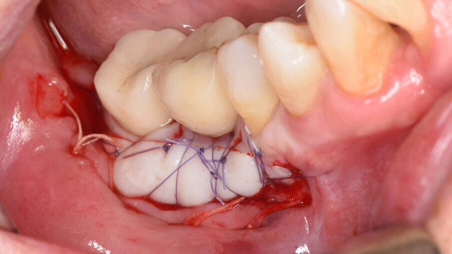 Fig. 14_Immagine clinica dopo vestiboloplastica con innesto epitelio connettivale per aumentare la banda di mucosa cheratinizzata intorno agli impianti.