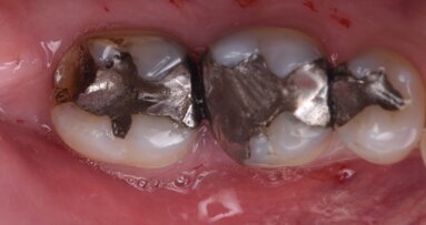 Immediate implant placement into two molar sockets