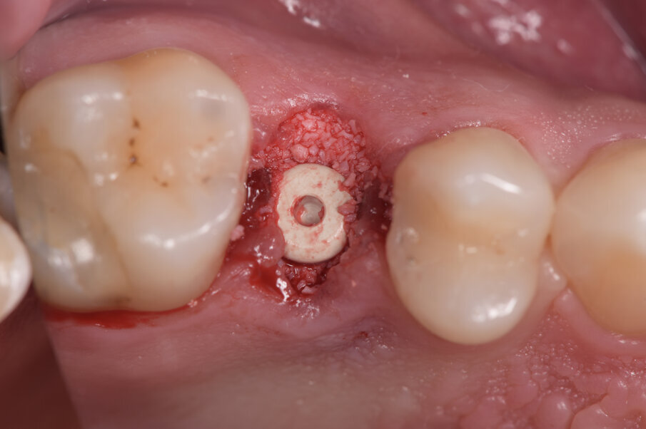 Fig. 3 - Visione occlusale, posizionamento impiantare secondo la tecnica flapp-less e riempimento tra gli spazi intraosseo-impianto. Sull’impianto è stato posizionato un tappo di guarigione a pressione.