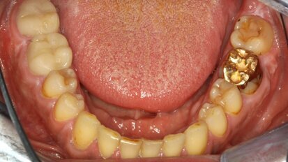 Tratamiento de paciente con endocarditis y caries activas