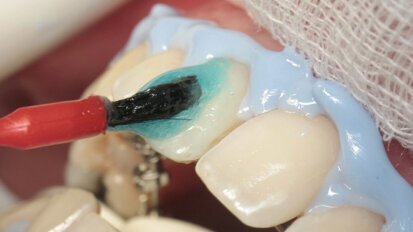 Figura 3. Aplicación de gel blanqueador de dientes en la cara vestibular de los dientes.