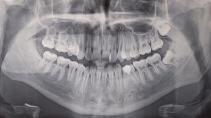 Gestione della terapia estrattiva: case report