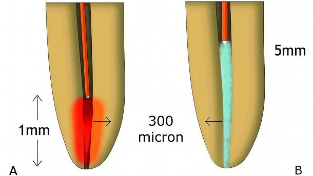 Le laser en endodontie (Partie II)