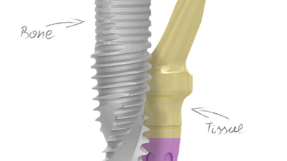 Revolucionaria innovación en implantes dentales