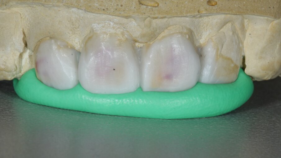 Fig 10: Putty Index of Wax-up