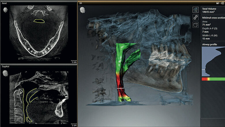 Fig. 1_Vie aeree superiori del paziente, visualizzata in SICAT Air. (Immagine: Dentsply Sirona).