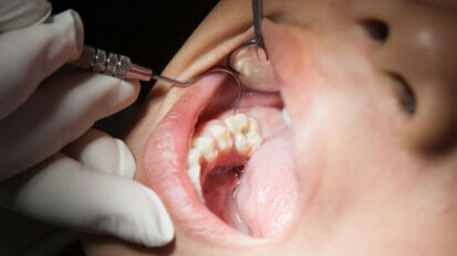 Individuati dalla ricerca vari trattamenti per la sigillatura dei denti