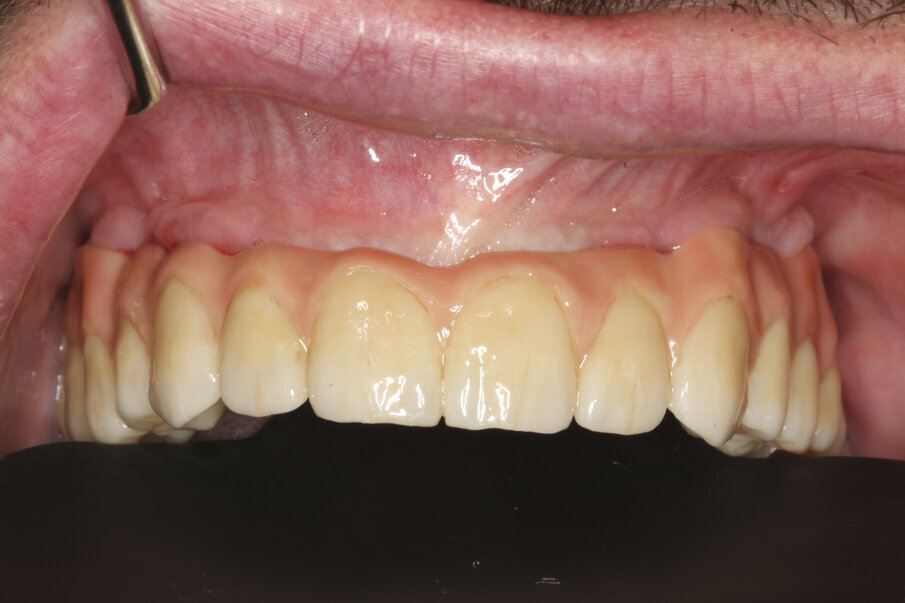 Fig. 18: Definitive prosthesis seated eight weeks after implant placement.