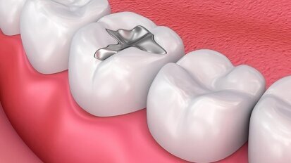 Preocupación por la eliminación prematura de la amalgama dental