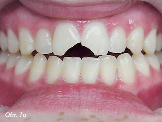 Obr. 1a: Klinický případ dvou nekomplikovaných fraktur korunky, kdy dva ulomené fragmenty byly nalezeny a znovu připevněny (fotografie poskytnuty American Association of Endodontists)
