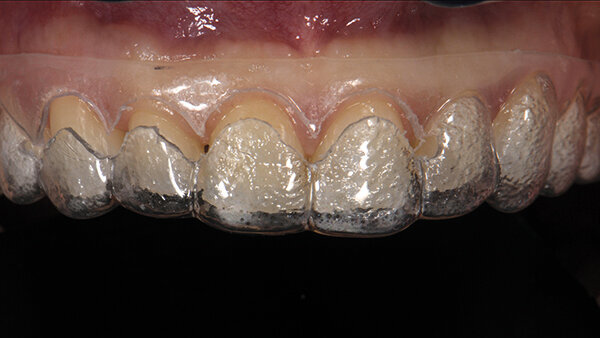 Figs. 6a y 6b. Ajuste intraoral de la guía quirúrgica para alargamiento de coronas.