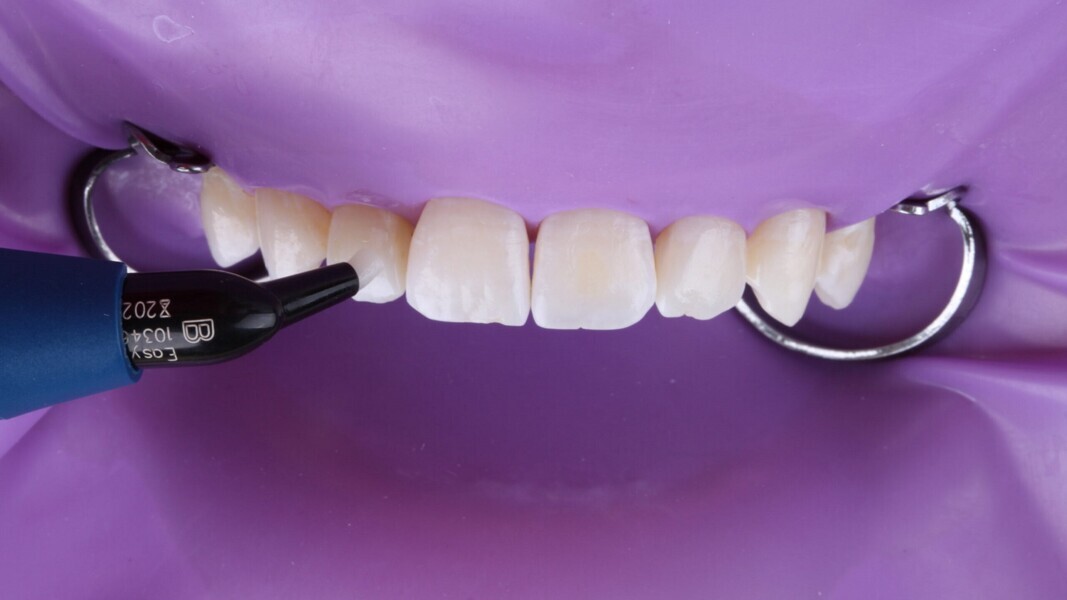 Fig. 10: 3M Filtek Easy Match aanbrengen in de kleur Bright.
