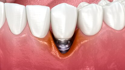 Particules de titane associées à l’échec des antibiotiques dans la péri-implantite