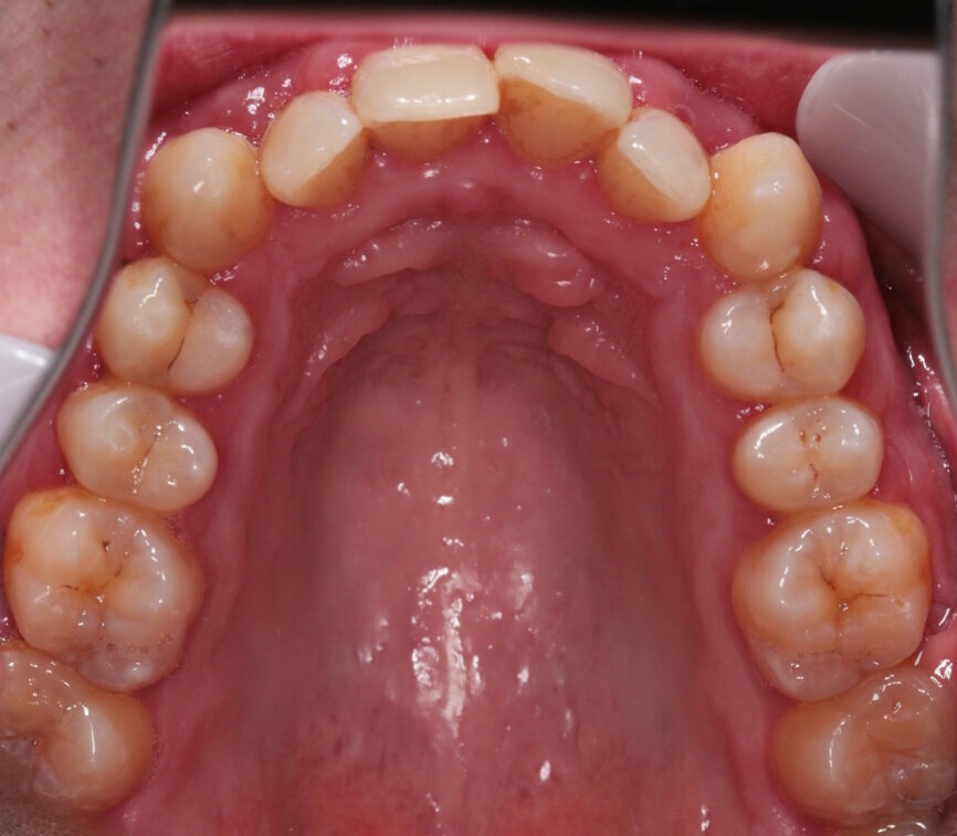 Fig. 5: Pre-treatment upper occlusal view