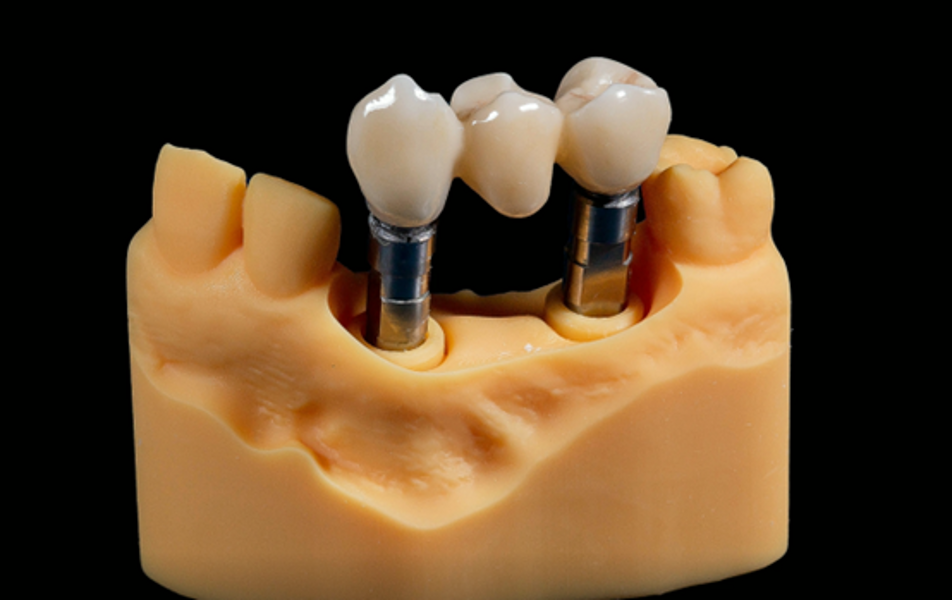 Fig. 11: Final restoration on the model, buccal view.