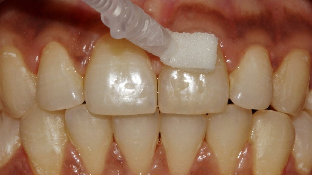 Curodont Repair Fluoride Plus: “Our experience has been extremely positive”
