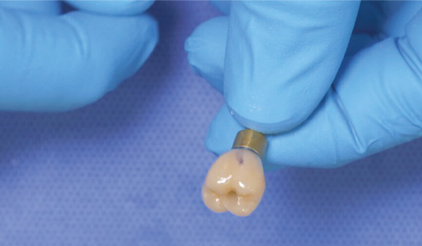 Fig. 14: Remove the index mark with alcohol and gauze. 