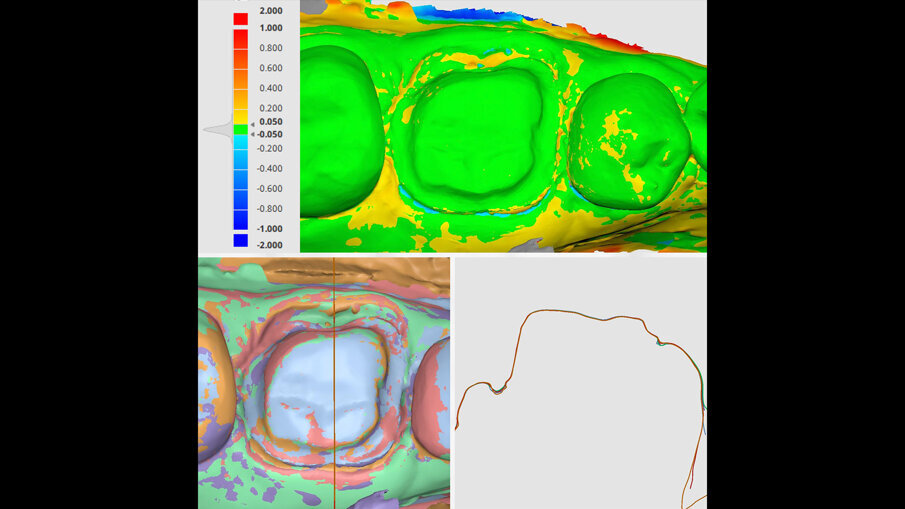 Fig. 14 - Mappa di deviazione delle scansioni rispetto alla scansione di CEREC Primescan (a; scala di 50 μm) e vista in sezione (b, c). Deviazione minima intorno all’area di preparazione.
