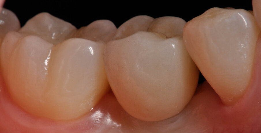 Fig. 15_Lo strato superiore realizzato in Vita Trilux Forte (sx).