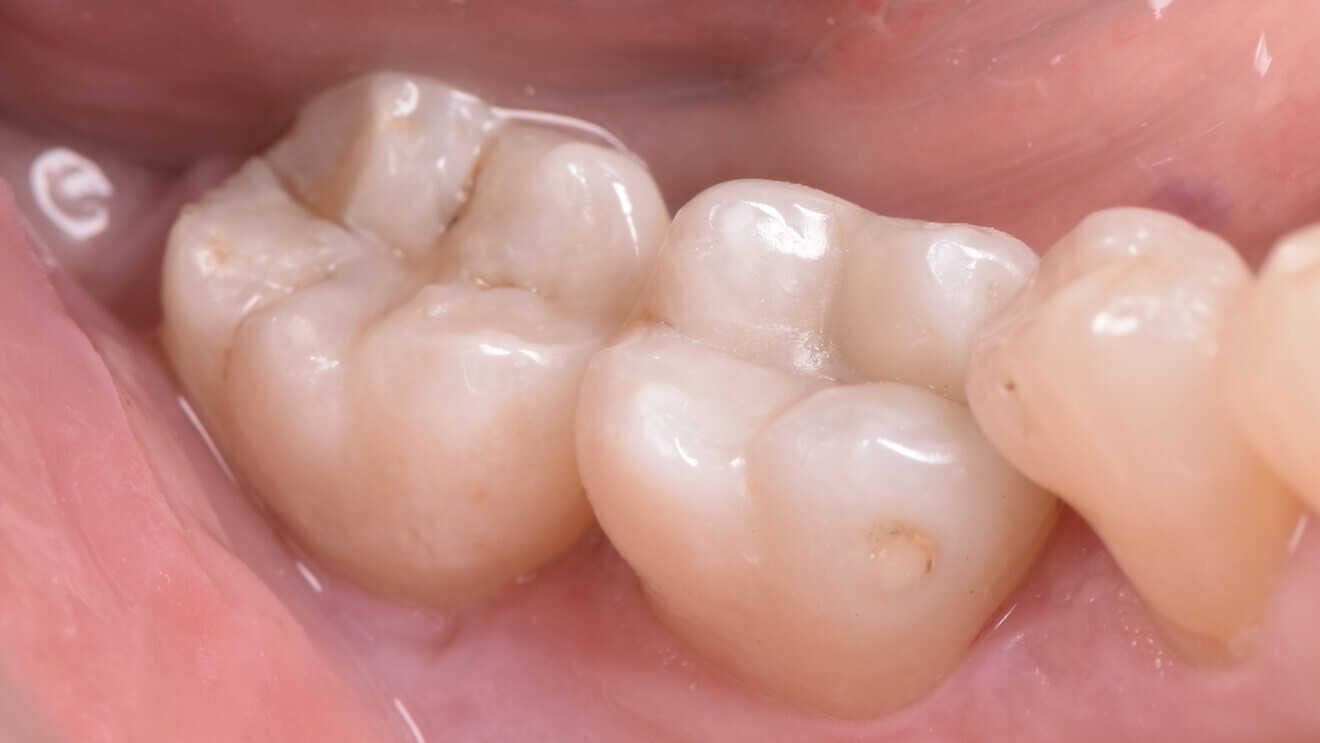 Fig. 8: Treatment outcome after dental dam removal: restorations that blend in well with the surrounding dentition—particularly in shade and surface gloss. 