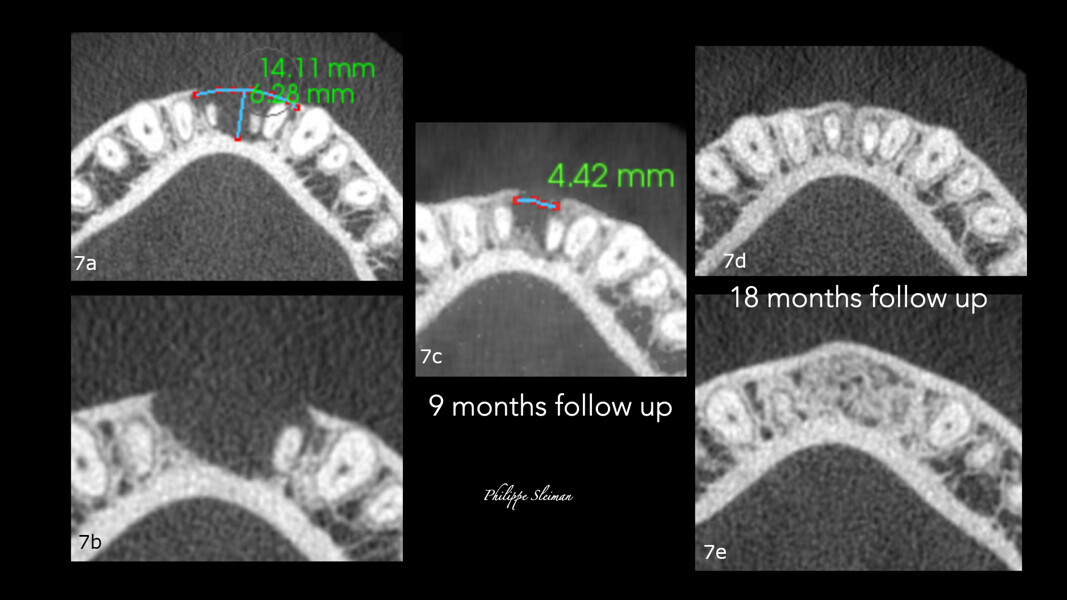 Figs. 7a–e: Comparison of the horizontal views of the i-CAT scans taken pre-op (a & b) and at the nine-month follow-up (c) and 18-month follow-up (d & e), showing complete healing of the area.