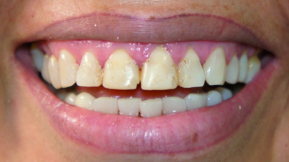 Ceramic and composite resin integration for custom smile design