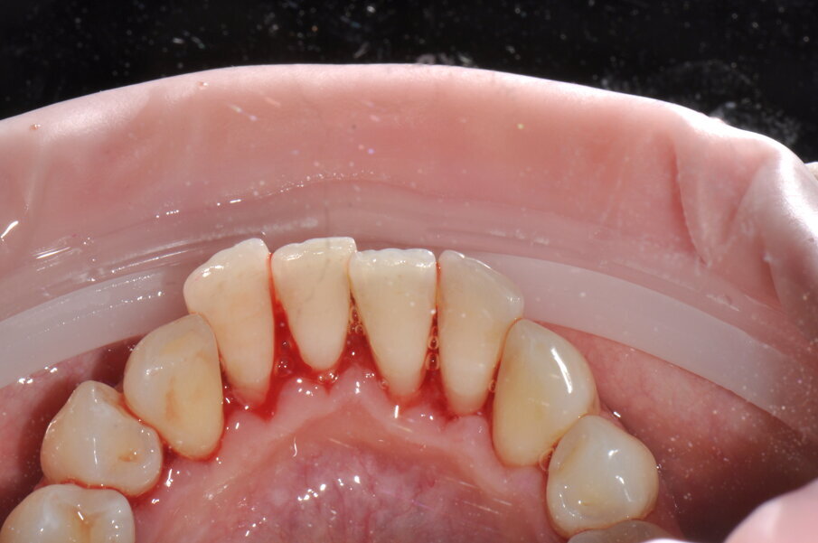 Figg. 3a-3c - Termine della terapia. nelle visioni vestibolare (3a), palatale (3b) e linguale (3c).