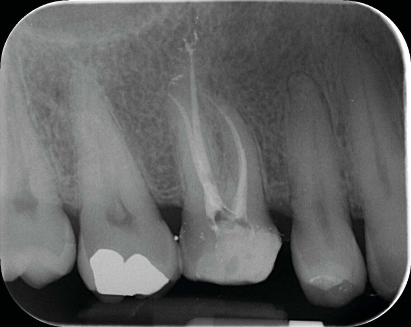 Fig. 6a : Exemple de traitement canalaire réalisé avec des instruments et techniques d’obturation de dernière génération : (a) radiographie préopératoire d’une molaire maxillaire présentant une nécrose pulpaire.