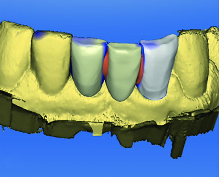 Fig. 13a: Anterior temporary crown printed using a preliminary CEREC 3-D Redcam impression. CAD of the IPS e.max FDP on CEREC inLab 4.3 (a).
Bonded IPS e.max bridge (b).