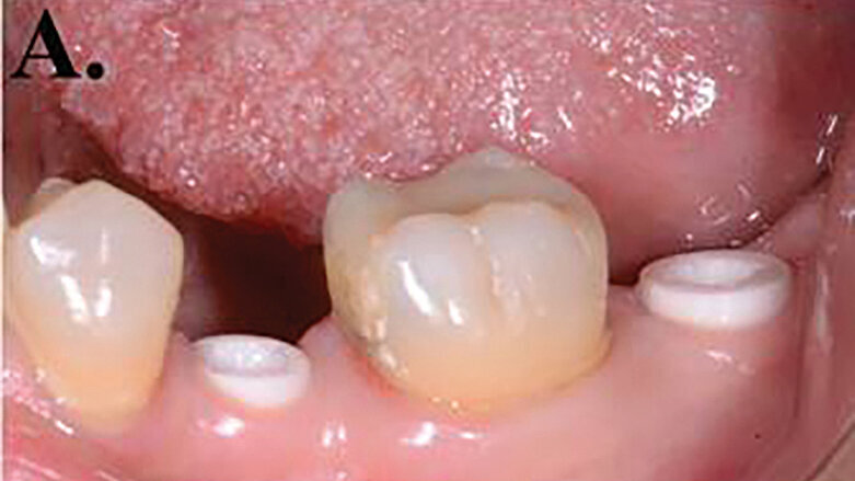 The future of implants: Advanced grade zirconia, the real strength