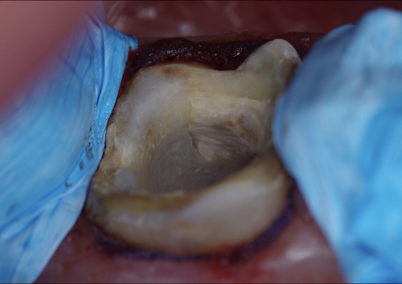 Fig. 19: Tooth ready for the adhesive pretreatment with Futurabond U. Teon tape protecting the neighbouring teeth and retraction cord placed.