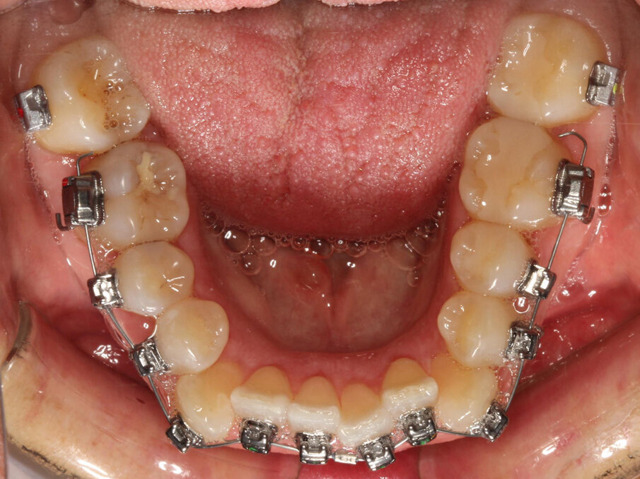 Initial treatment