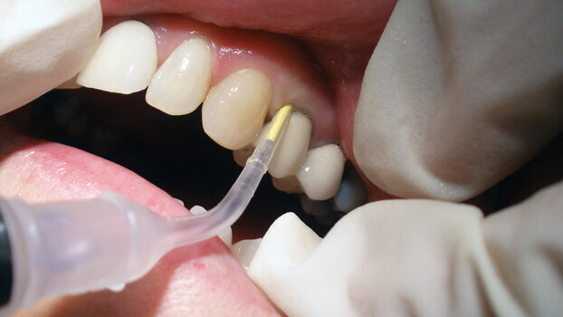 Pest control in gums gardening: Locally applied antimicrobials as adjuncts to nonsurgical periodontal therapy