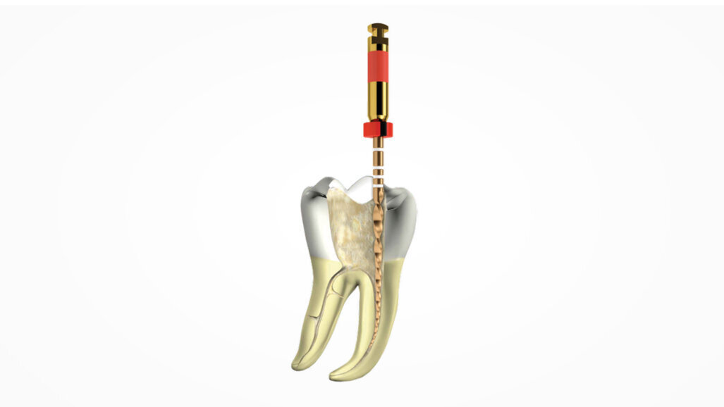 WaveOne Gold turns ten: Dentsply Sirona celebrates a decade of endodontic innovation