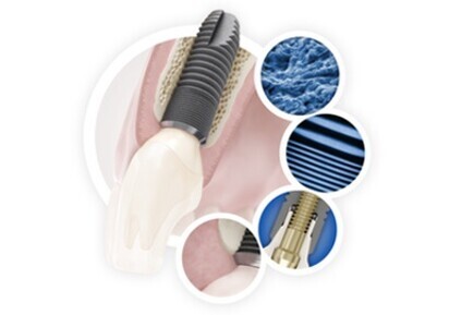Simplicity without compromise with the new ASTRA TECH Implant System EV
