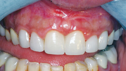 Unique maxillary frenectomy with a diode laser