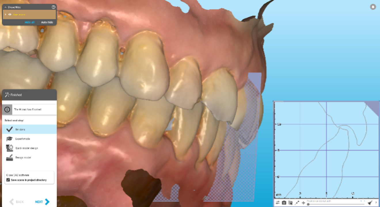 Figs. 1a & b: Side-by-side cross-sectional analysis of the initial (a) and post-restorative treatment position (b), highlighting vertical space creation with orthodontic treatment.