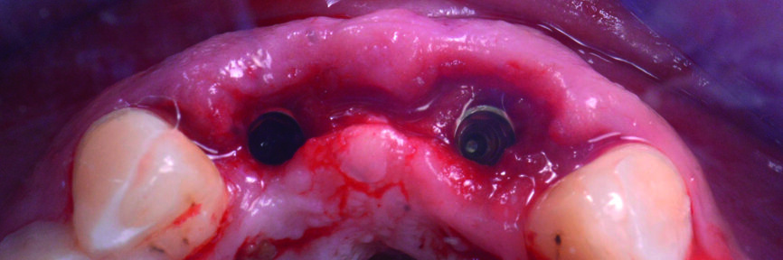 Fig. 16 : Vue occlusale des implants après la pose