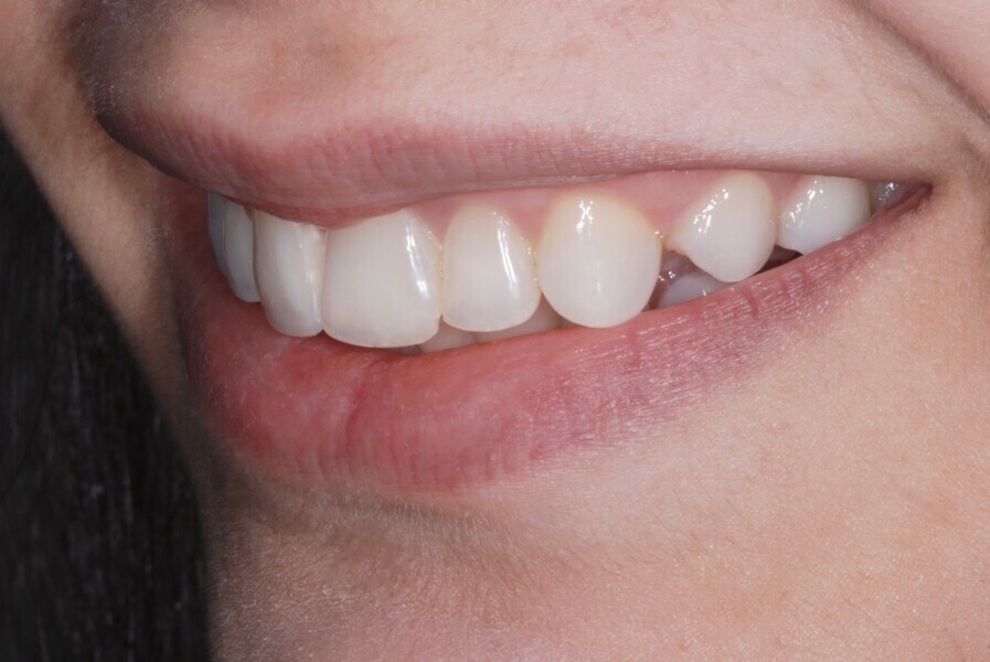 Fig. 22: Smile left side view after treatment. 