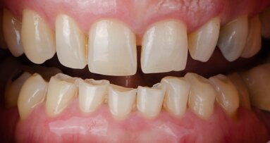 Early diagnosis is key: GC Dental Campus webinar to discuss direct restorations for tooth wear
