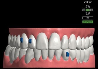 ClearCorrect’s next-generation treatment setup