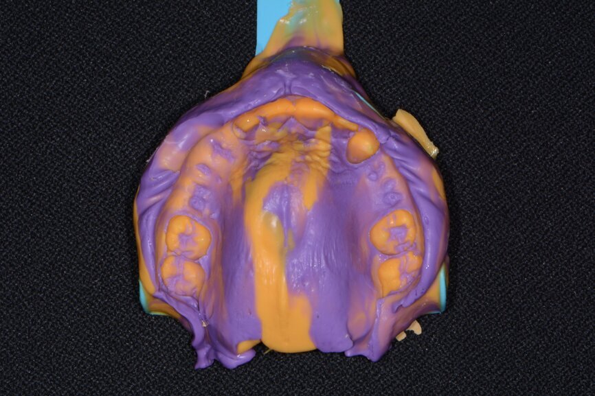 Fig. 7: Maxillary impression (Kettenbach).