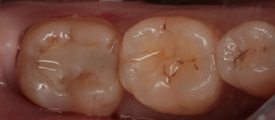Fig. 23_Visione occlusale di 46 e 47.