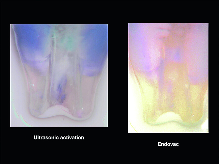 Fig. 2c: Sleiman-Iandolo testing. Results of the dye removal with PUI (left) and a negative pressure irrigation unit used at the intervals suggested as part of the Sleiman sequence (right). Note the extreme cleanliness of the deepest recesses of the dentinal tubules in the image on the right.