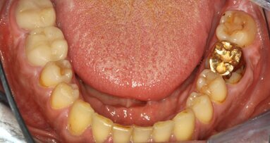 Tratamiento de paciente con endocarditis y caries activas