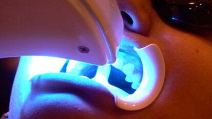 El descontrolado uso de lámparas de blanqueamiento dental