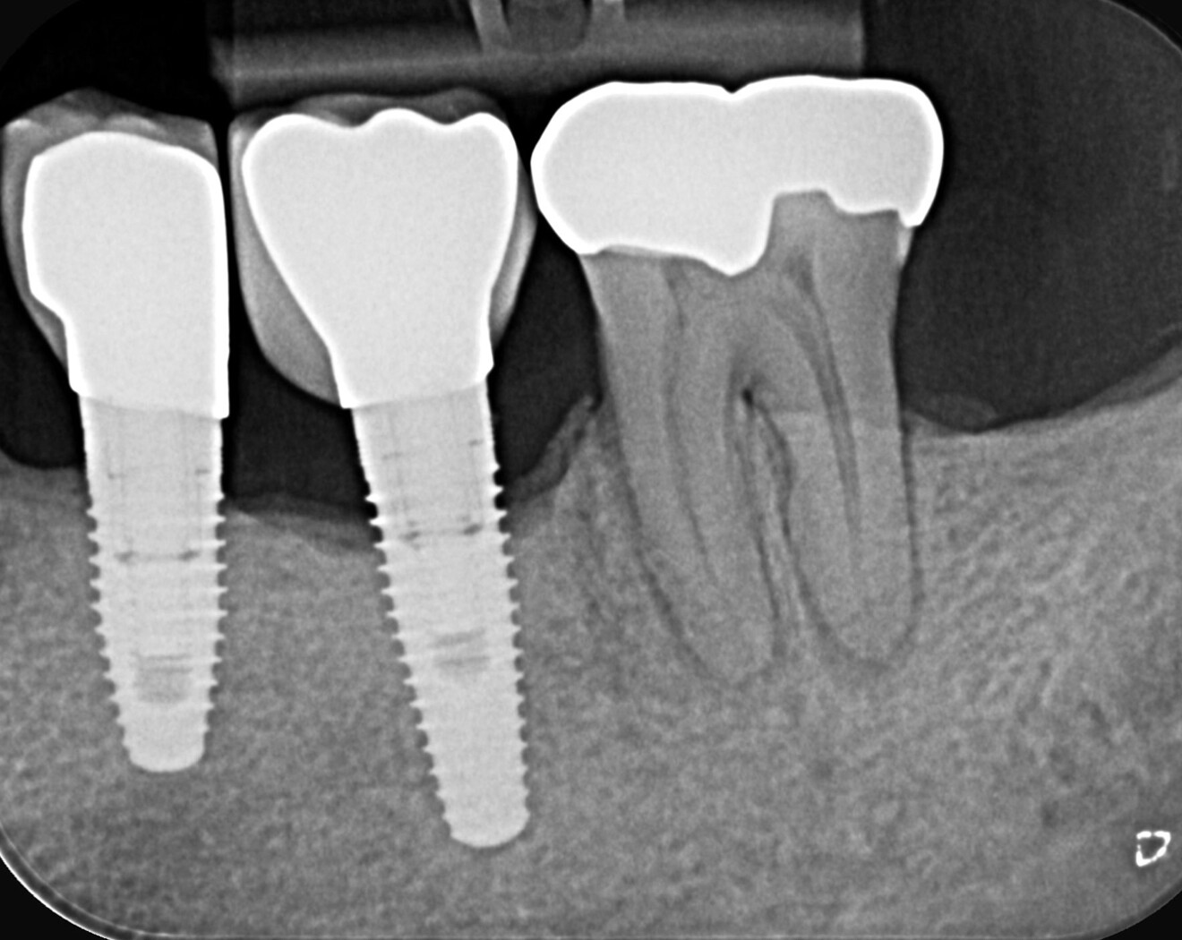 Fig. 9: Pre-op radiograph showing calcification along the entire length of the canals.