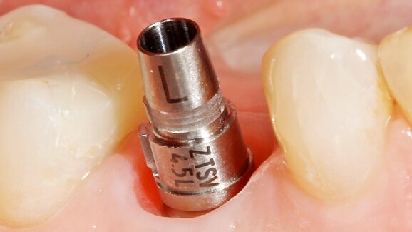 CEREC-Webinar: Klinische Aspekte des digitalen implantologischen Workflows