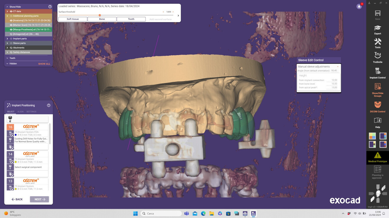 Fig. 3: Virtual implant planning. Matching of CBCT and intra-oral scans using an external marker in exoplan 3.1.