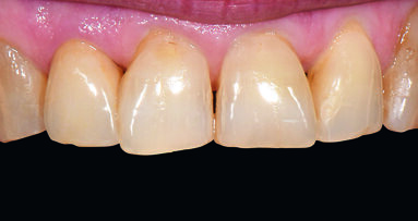 Precisely controlling shade saturation with VITA AKZENT Plus CHROMA STAINS